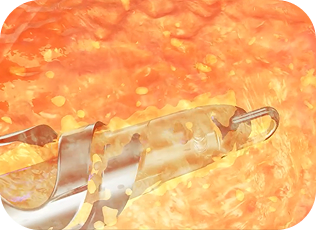 Illustration of the Santreva-ATK Atheroplasty device cutting and extracting a cylindrical section of arterial plaque.