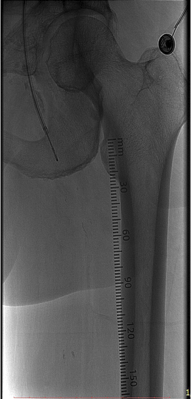 Angiography during revascularization