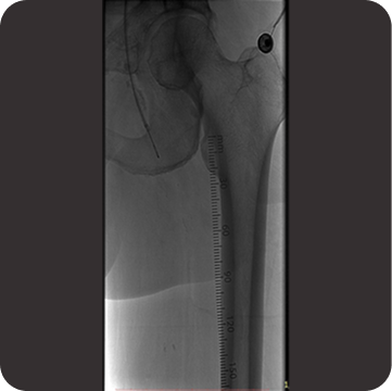 Antegrade access at the proximal CTO cap