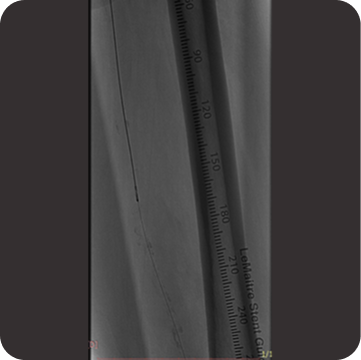 Santreva-ATK distal crossing