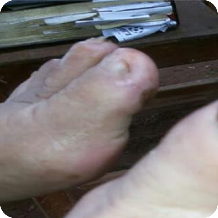 Healed ischemic foot six months after the procedure