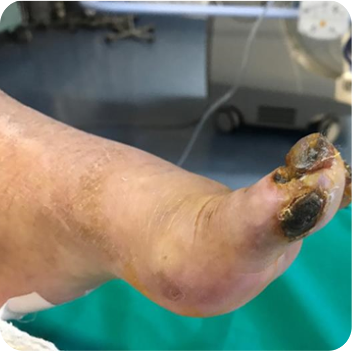 Baseline ischemic foot with non-healing toe ulcers