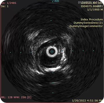 IVUS after CTO crossing