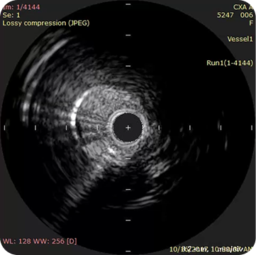 IVUS view after revascularization